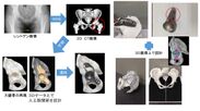 J・3D 金属3Dプリンターで日本初の「カスタムメイド人工股関節」を開発開始