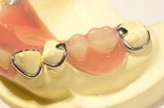 従来の入れ歯：両側の健康歯を削って溝を作り、固定金具を引っ掛ける
