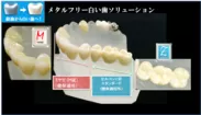 図4：メタルフリー、白い歯ソリューション