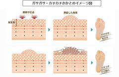 ガサガサ・カチカチかかとのイメージ図