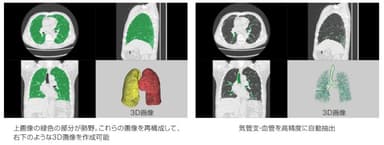 AI技術を用いた間質性肺炎の診断支援技術の共同開発