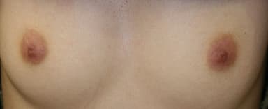乳首治療6週後