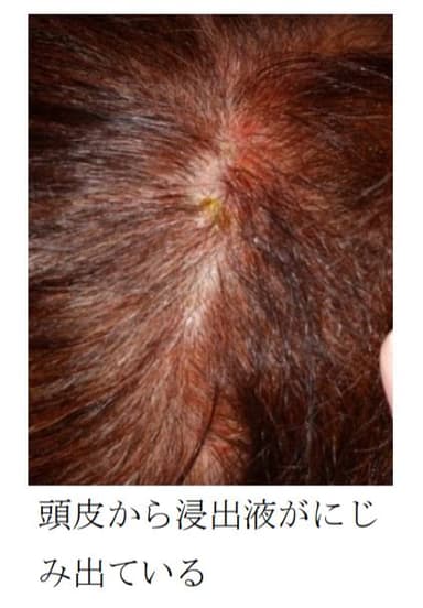 頭皮のアレルギー。