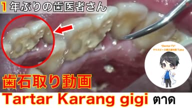 1年でも歯石が溜まります。日々の歯磨き大切です！！