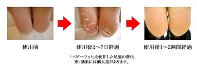 「ベビーフット」を使用した足裏の変化