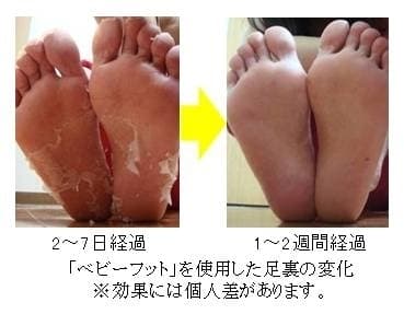 「ベビーフット」を使用した足裏の変化