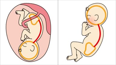 (左)お腹の中では背中はCのように丸い(通称Cカーブ)。／(右)生まれてすぐ。背中はCカーブを保っている。