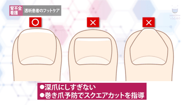 透析患者のフットケア