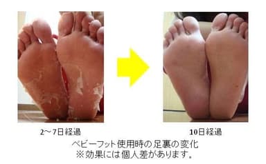 ベビーフット使用時の足裏の変化