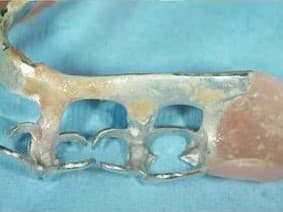 汚れが蓄積された部分入れ歯
