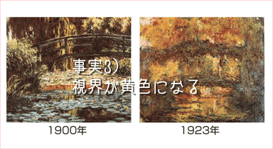 白内障事実3