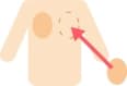乳腺再建インプラント法