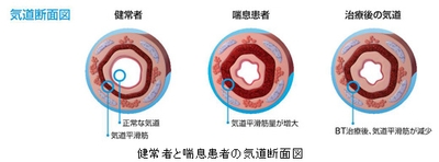 健常者と喘息患者の気道断面図