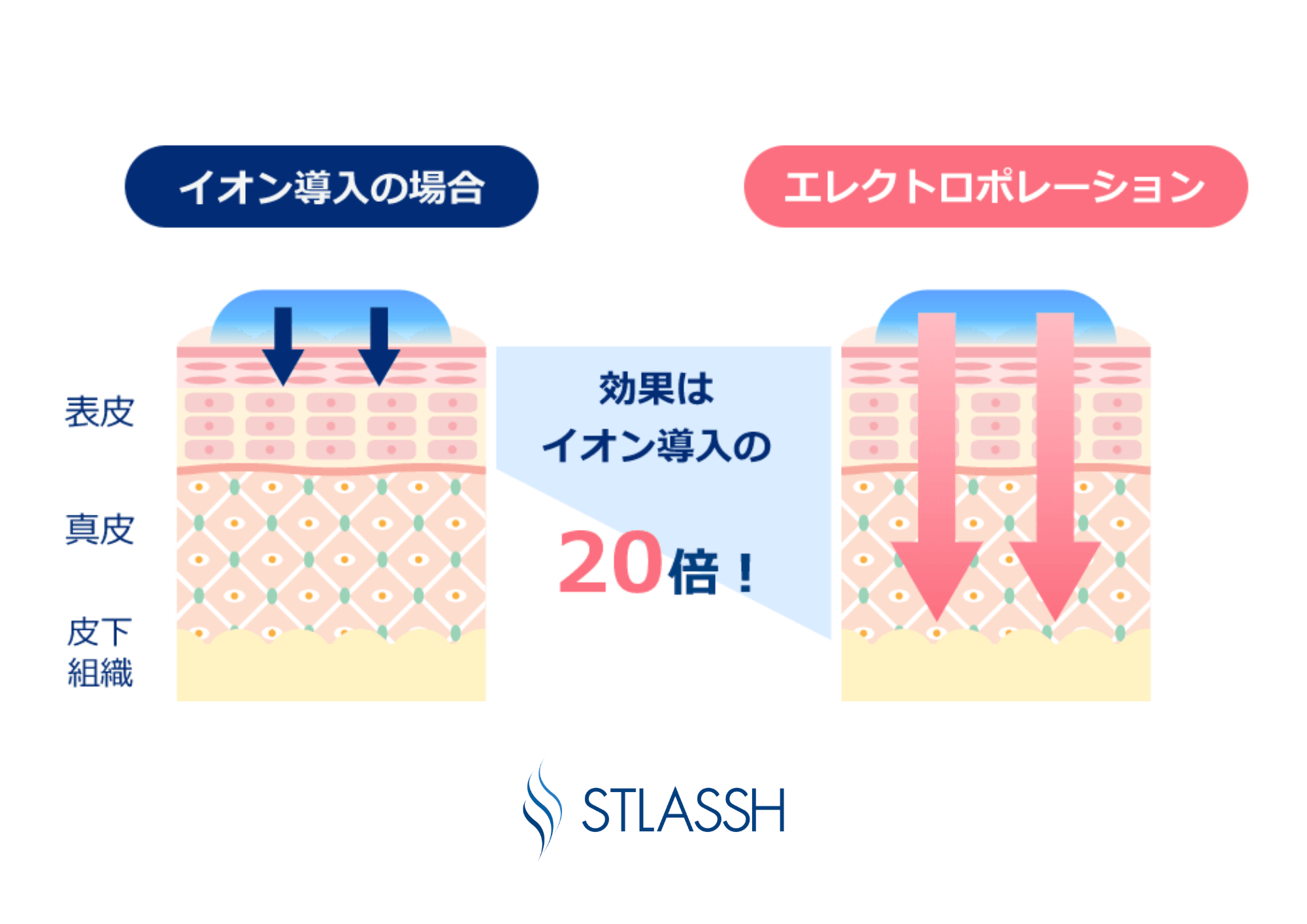 業界初の新技術、 エレクトロポレーション脱毛に新しいコースが誕生