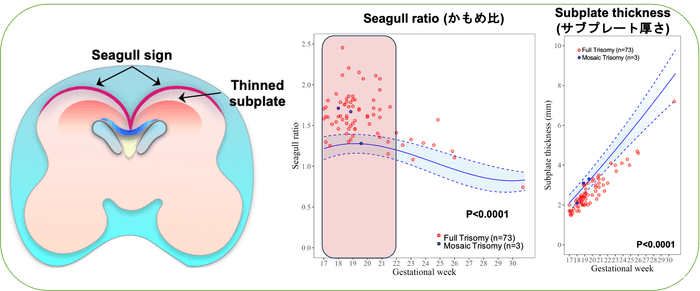 ダウン症の脳ではかもめが羽を広げた様な脳表面の形(かもめサイン、Seagull sign)と脳の薄いサブプレート(Thinned subplate)が特徴的です(左図)。ダウン症のある胎児では、かもめ比とサブプレート厚さの傾向は類似していますが、一人ひとり違う値を示しています。