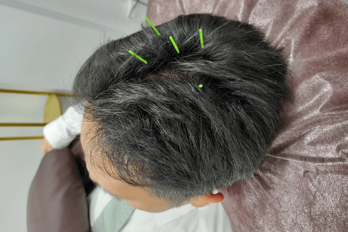 国家資格者による鍼灸とヘッドケアを融合した独自の施術。出張時も企業の要望に合わせ、本格的な鍼施術によるコンディショニングが可能。