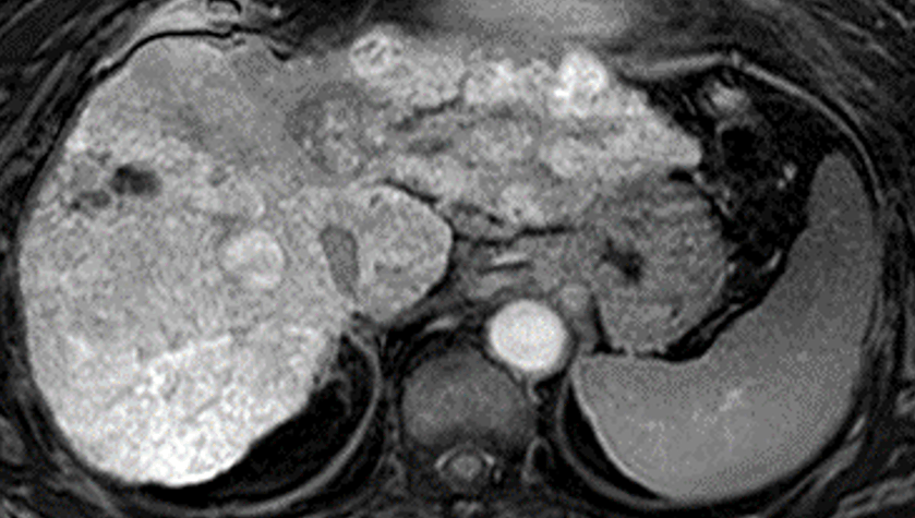 EOB-MRI肝細胞相の画像