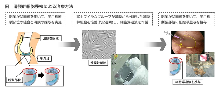 富士フイルムと東京医科歯科大学 半月板損傷を対象とした、世界初の