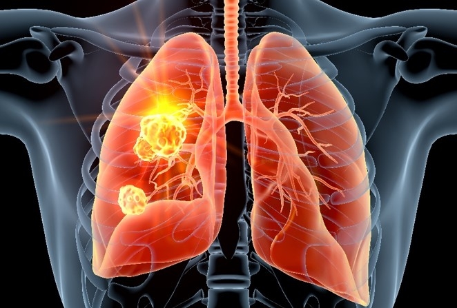 肺がんのイメージ図