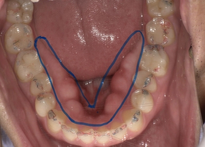 青ラインで囲まれた範囲が骨隆起と言われる、食いしばりなどの力に反応して骨が盛り上がっている部分