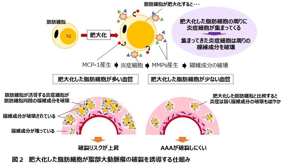 腹部大動脈瘤の破裂機構を解明　農学部応用生命化学科　准教授　財満信宏らの研究チーム　血管壁内の脂肪細胞が原因　予防薬・機能性食品開発に期待