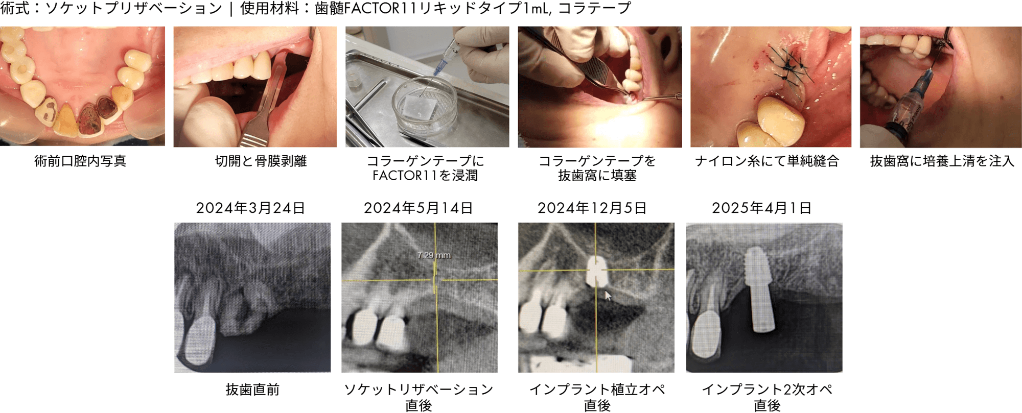 ソケットプリザべーション症例