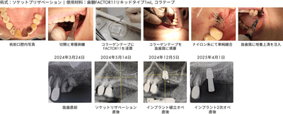 ソケットプリザべーション症例