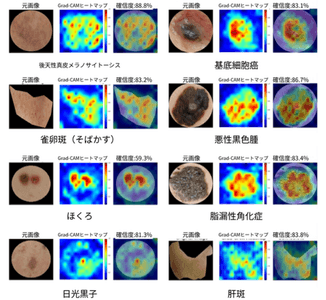 AIが「どこを見て診断したか」を示すヒートマップ