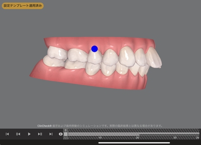舌や唇の癖により、年齢とともに上の歯並びが前に出てきてしまったケース（治療前）