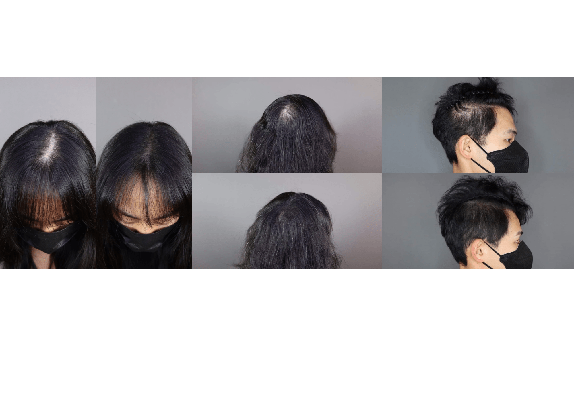 施術画像(分け目が気になる方/つむじ付近が気になる方/サイドが気になる方)