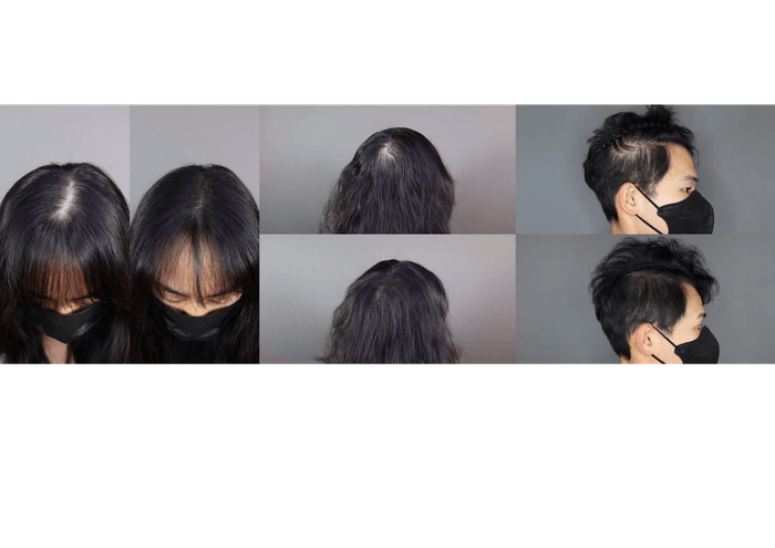 施術画像(分け目が気になる方/つむじ付近が気になる方/サイドが気になる方)