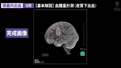 頭蓋内出血(血腫量計測)