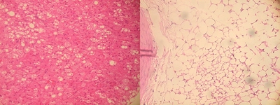 脂肪分と糖分の過剰摂取では血管異常の発生部位が異なることを発見　新たな血管疾患予防法の開発に期待