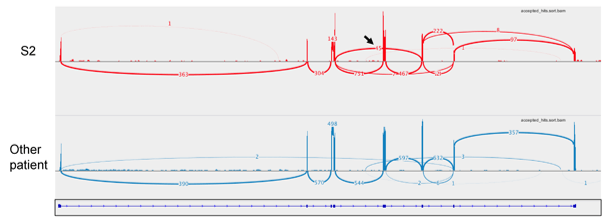 図2 NDUFV2遺伝子のエクソンスキップ: 患者(S2)のエクソン5は一部の転写産物でエクソンスキップが生じています(矢印)。