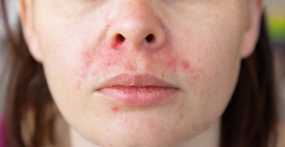 脂漏性皮膚炎の症状例