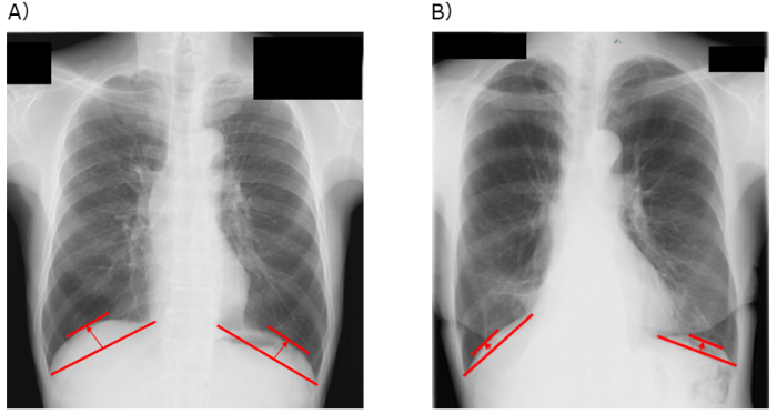 肺がん患者の手術前の横隔膜の位置と予後の関連性を検証　手術のリスク評価や治療戦略立案への貢献が期待される研究成果