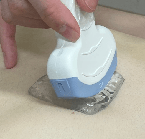 ベタつかない、拭き取り不要な超音波診断用のゲルパッドを開発 今後臨床応用することで、検査時の患者満足度向上に期待