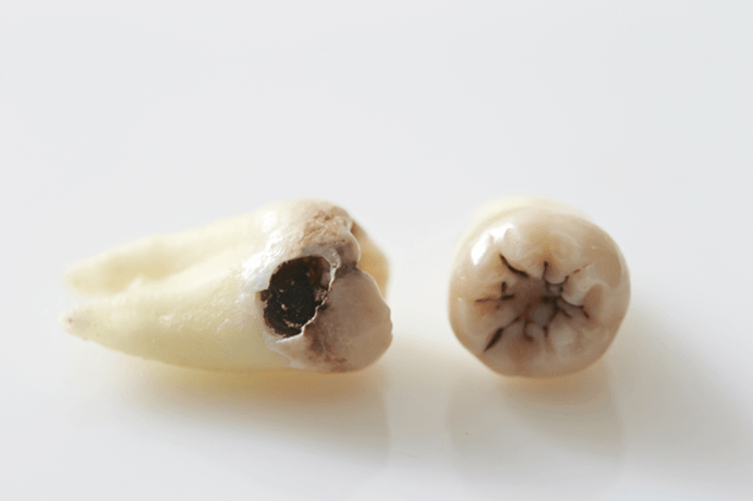 大正健康ナビ、5/29に新着情報「虫歯」を公開!