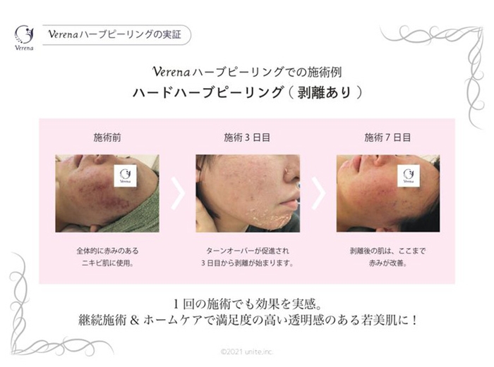 Verena(ヴェルナ)のハードハーブピーリングの施術による実感