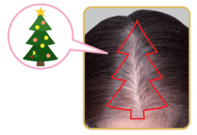 クリスマスツリーのような三角形に脱毛する進行パターン