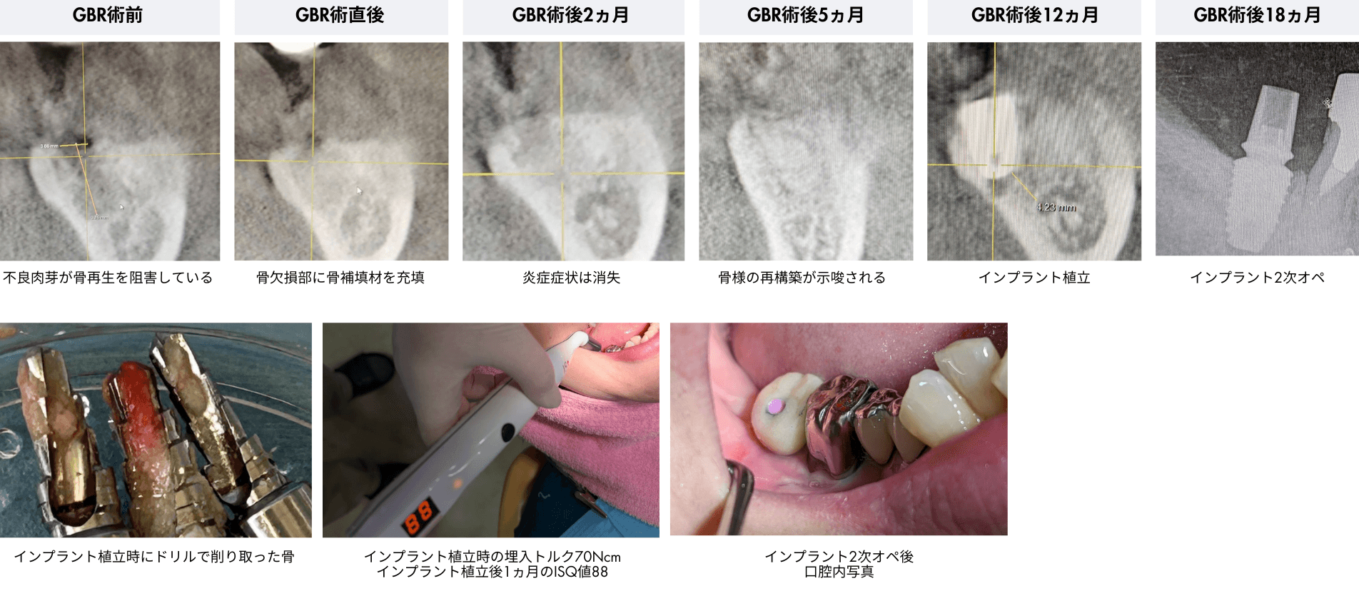 GBRからインプラント植立までの推移