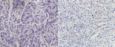 世界初！免疫チェックポイント阻害剤の有効性を事前予測　個々の患者に適した肝がん薬物治療法の確立に期待