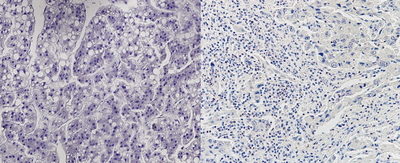 ヒト肝がん細胞