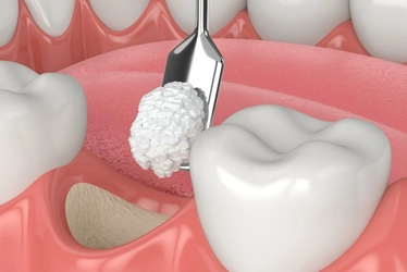 幹細胞培養上清液を使用した革新的な骨再生インプラント治療の提供を開始