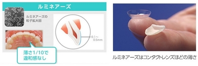 コンタクトレンズ級の極薄セラミックで、痛みを抑えて理想の白い歯へ