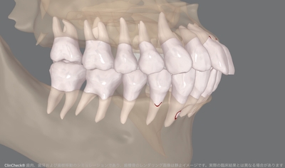 矯正前のデジタルスキャンデータにCT画像を組み合わせたイメージ