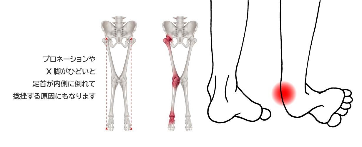 踵のあたりやX脚