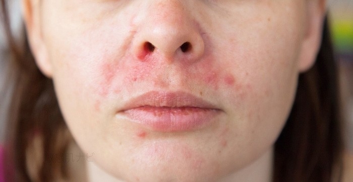 脂漏性皮膚炎 酒さ