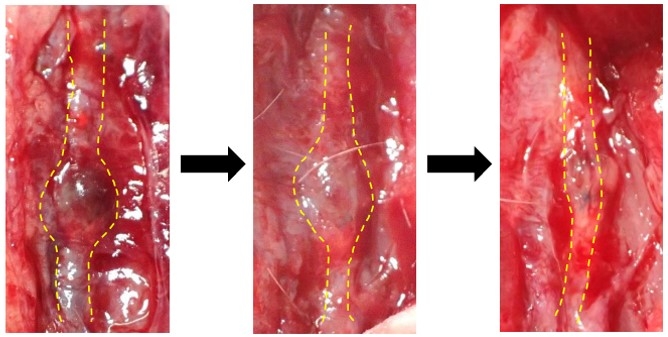 左:形成された腹部大動脈瘤、中央:トリカプリン投与後経過、右:トリカプリン投与により腹部大動脈瘤が縮小