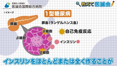 1型糖尿病について糖尿病の専門医が解説する動画を投稿/教えて医誠会